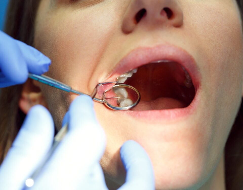 Root Canal Treatment: Common Myths Debunked